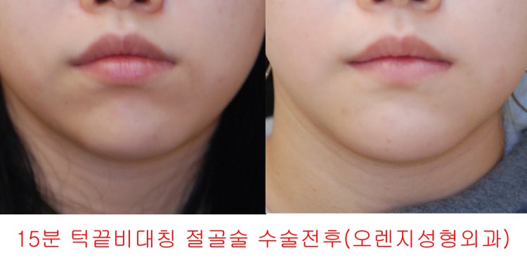 사각턱 턱길이,턱근육 질문 : 지식iN