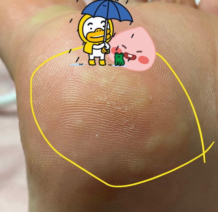 발바닥 가려움 : 지식In