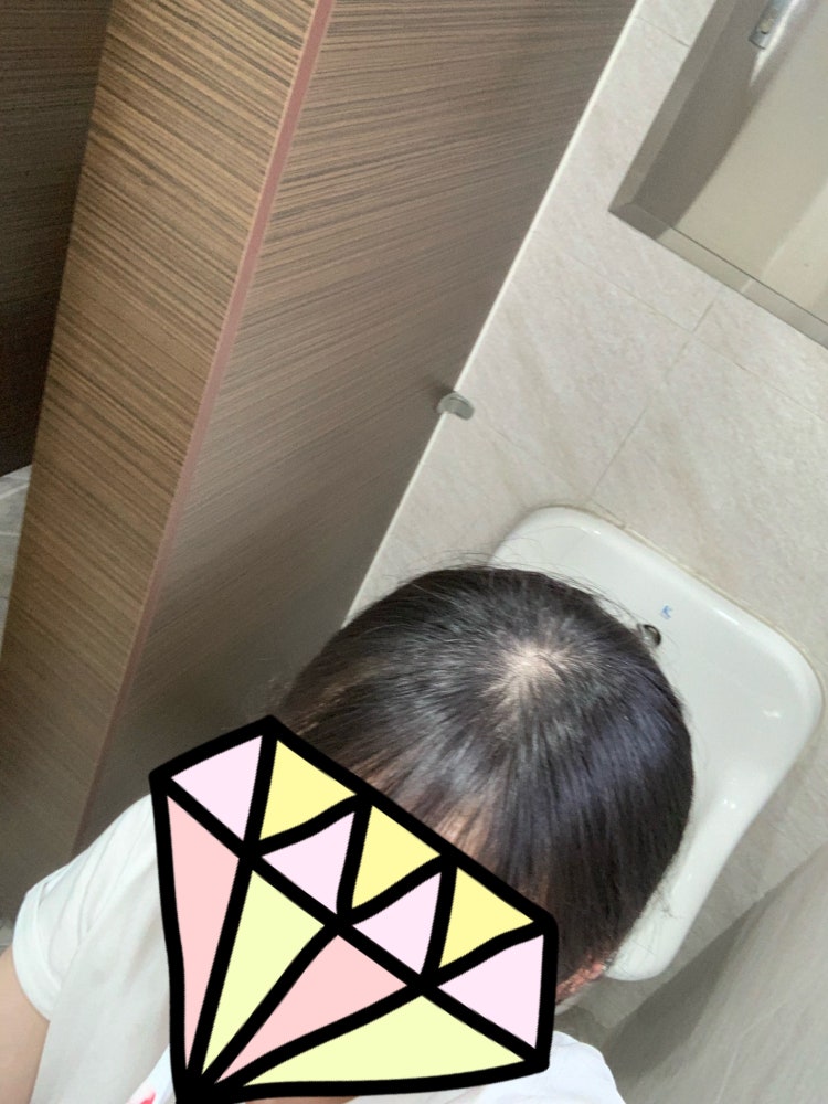 20대 여자 탈모 : 지식iN 20대 여자 탈모 : 지식In