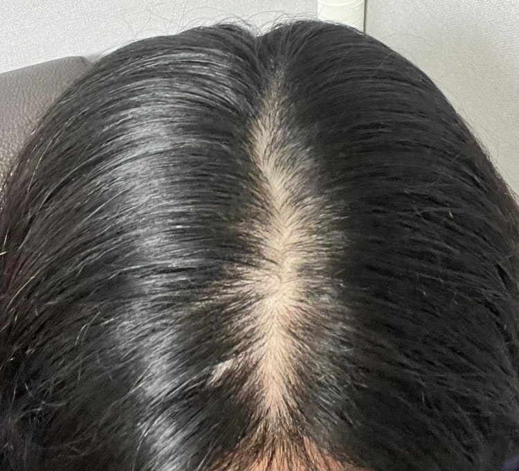여자 가르마탈모 : 지식iN 여자 가르마탈모 : 지식In