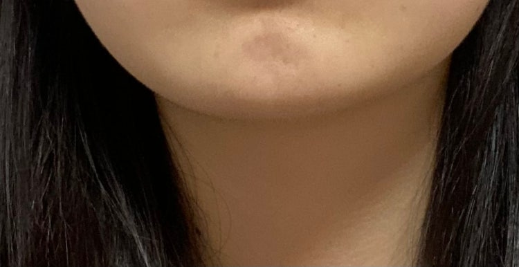 자갈턱 보톡스 : 지식iN