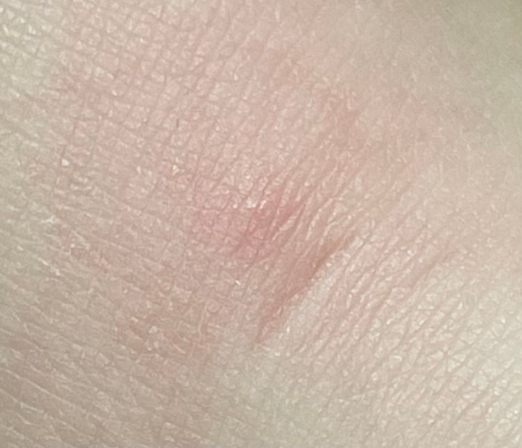 피부에 물집 인데 이게 뭘까요? : 지식iN