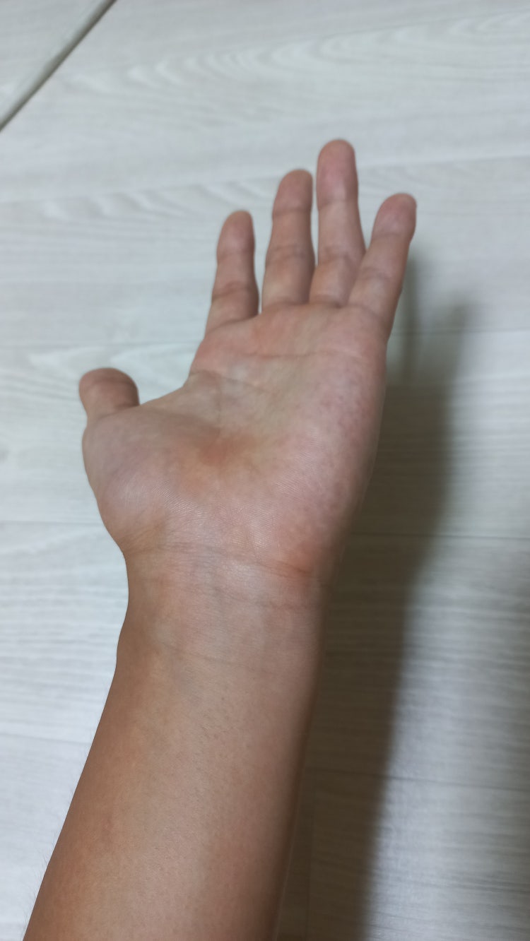 손바닥 가려움 : 지식In