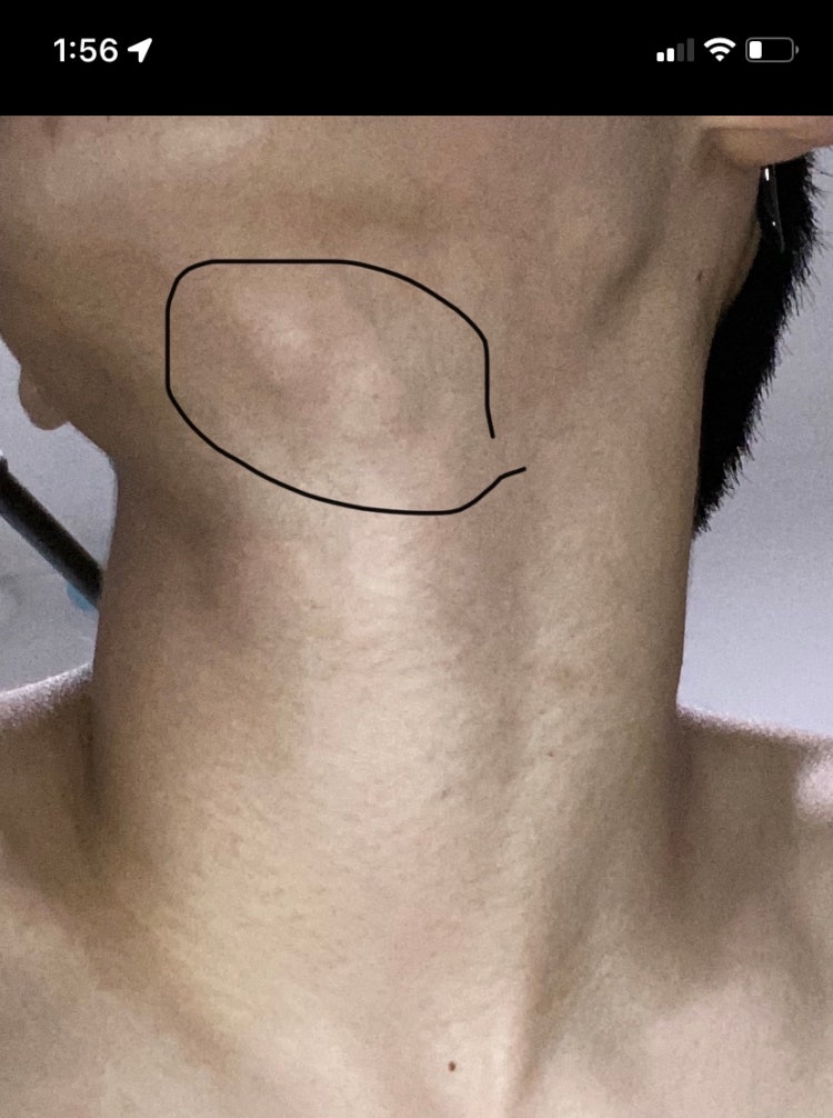 턱밑 멍울, 귓볼 옆 멍울 : 지식iN