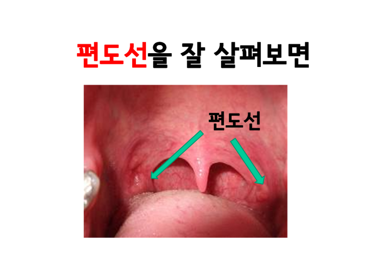 편도 결석 : 지식iN 편도 결석 : 지식In