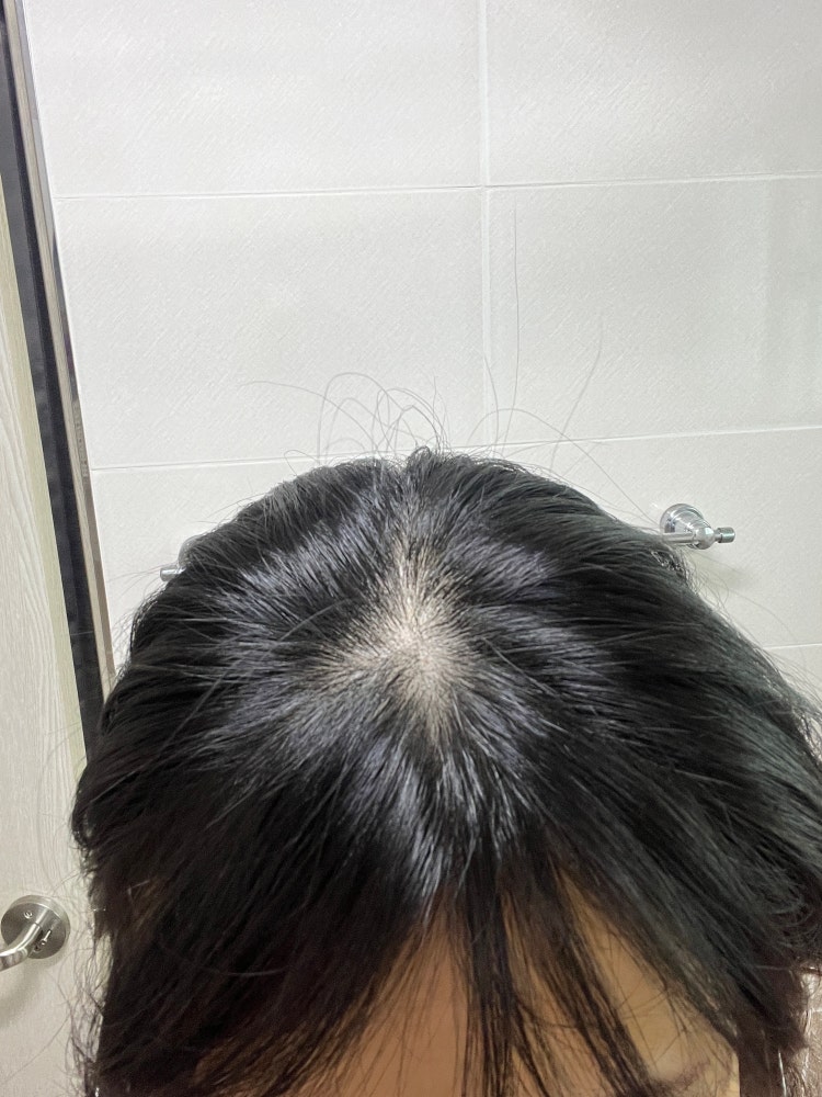 여자 앞머리 탈모 : 지식iN 여자 앞머리 탈모 : 지식In