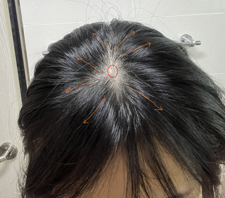 여자 앞머리 탈모 : 지식iN 여자 앞머리 탈모 : 지식In