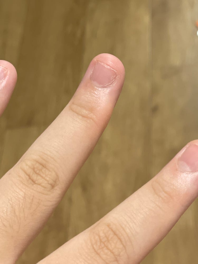 중지 손가락 굳은살 : 지식iN 중지 손가락 굳은살 : 지식In