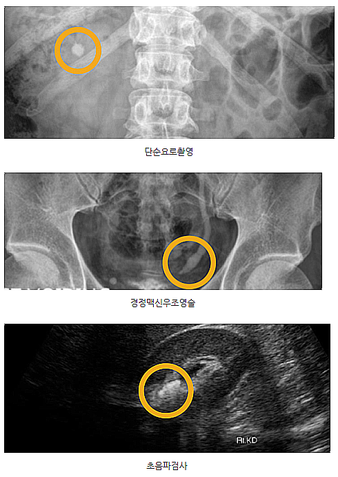 요로결석... : 지식iN 요로결석... : 지식In