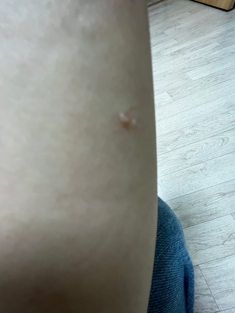 피부 수포 : 지식iN