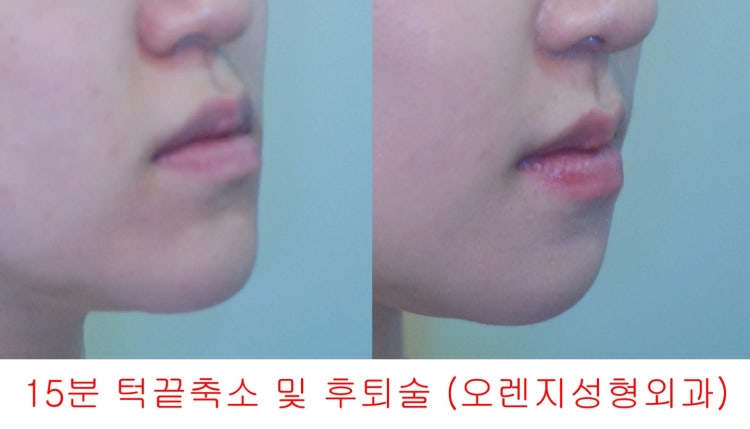 턱 빠짐 턱 길어짐 : 지식iN