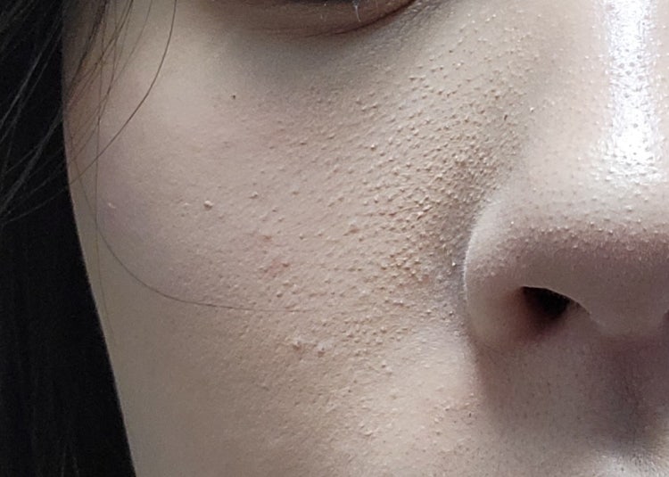 피부요철..어떻게 하죠? : 지식iN