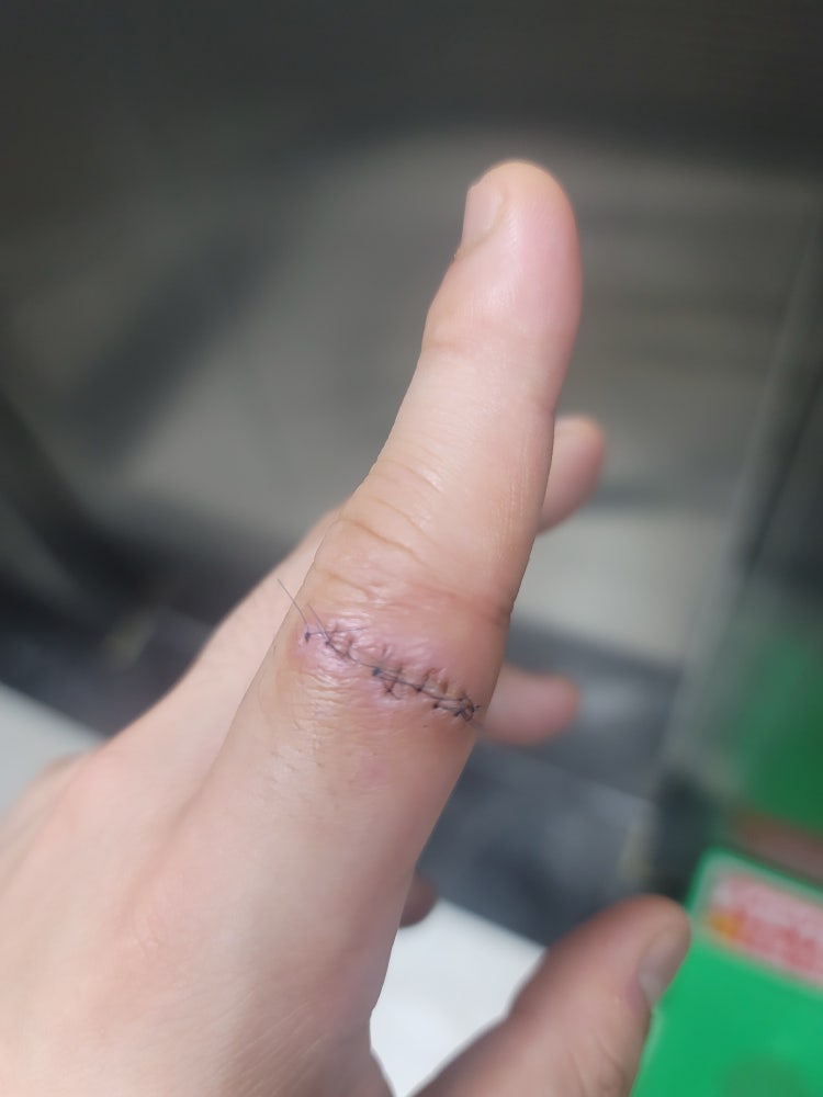 손가락 봉합 시술 : 지식In