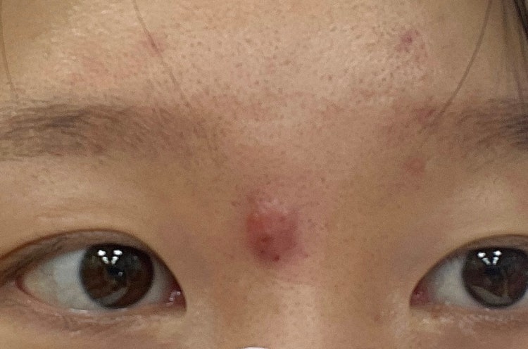 표피낭종 치료 : 지식iN 표피낭종 치료 : 지식In