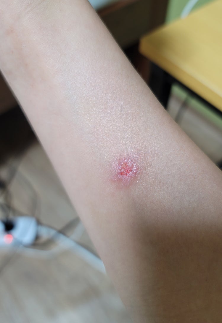 옴진드기 완치 방법 : 지식iN