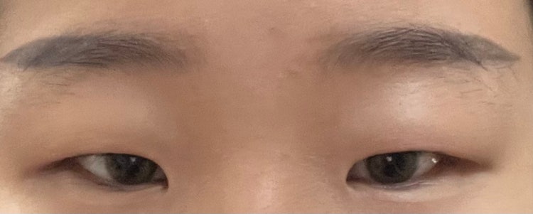 절개 쌍수 속쌍 될까요? : 지식iN