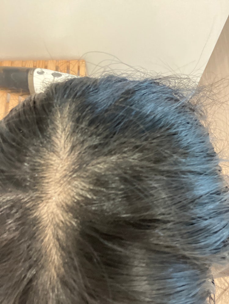 10대 여자 탈모 : 지식iN 10대 여자 탈모 : 지식In