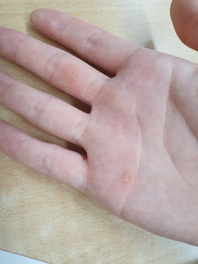 중지손가락 3번째 마디 외에도 굳은살이 있어요 : 지식iN 중지손가락 3번째 마디 외에도 굳은살이 있어요 : 지식In