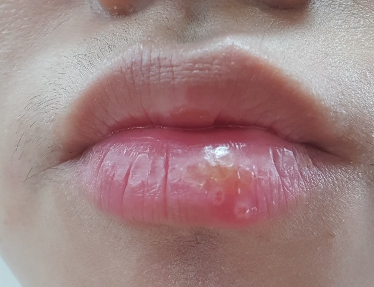 입술 수포 사진좀 확인 부탁드립니다. : 지식iN