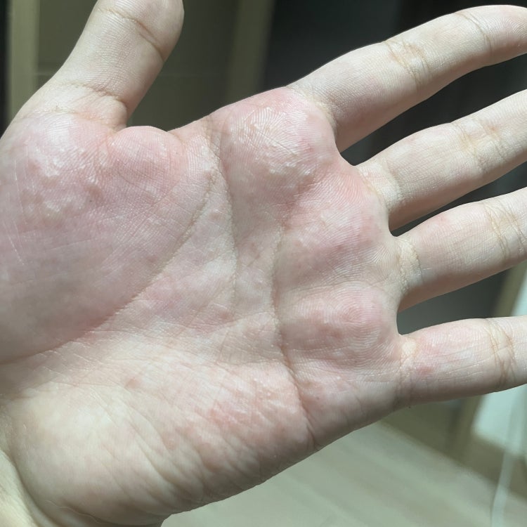 매독 성병 증상 질문 : 지식In