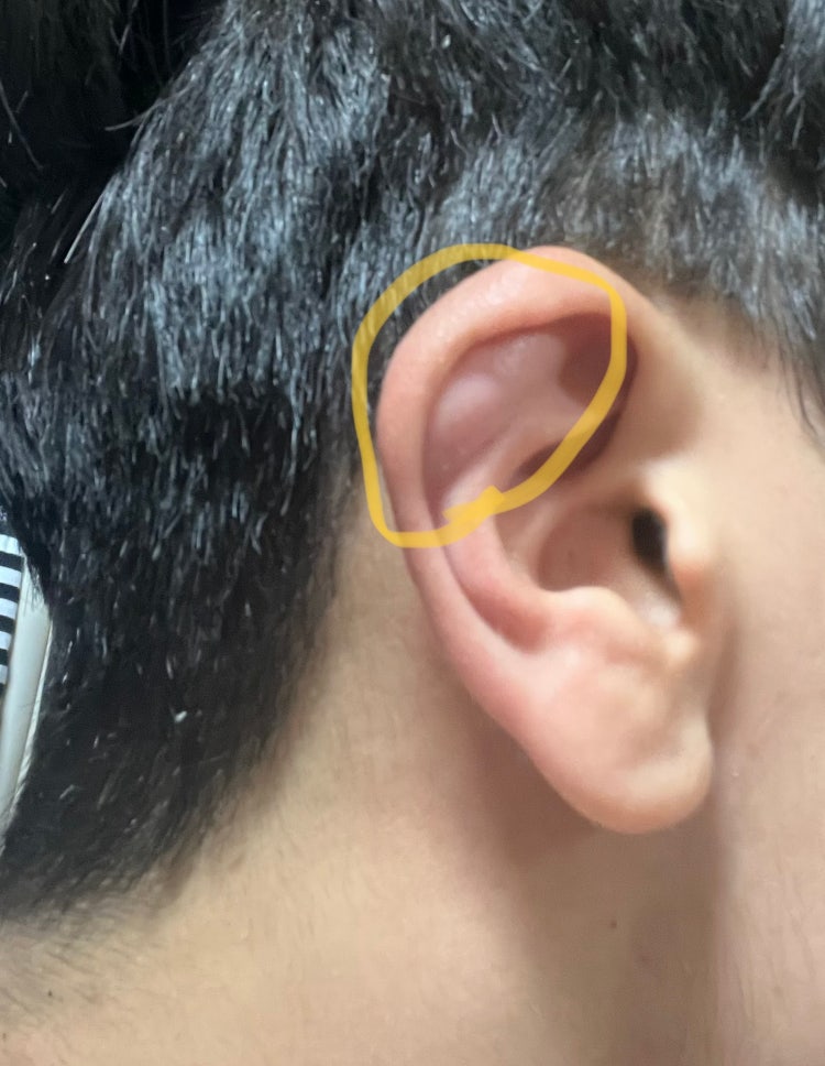 귀 위쪽이 부었어요 : 지식iN
