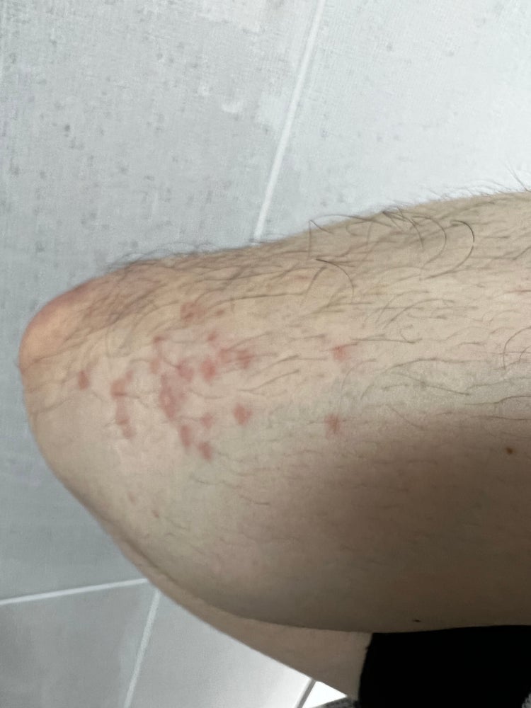 피부 발진? 붉은색 점들 : 지식iN
