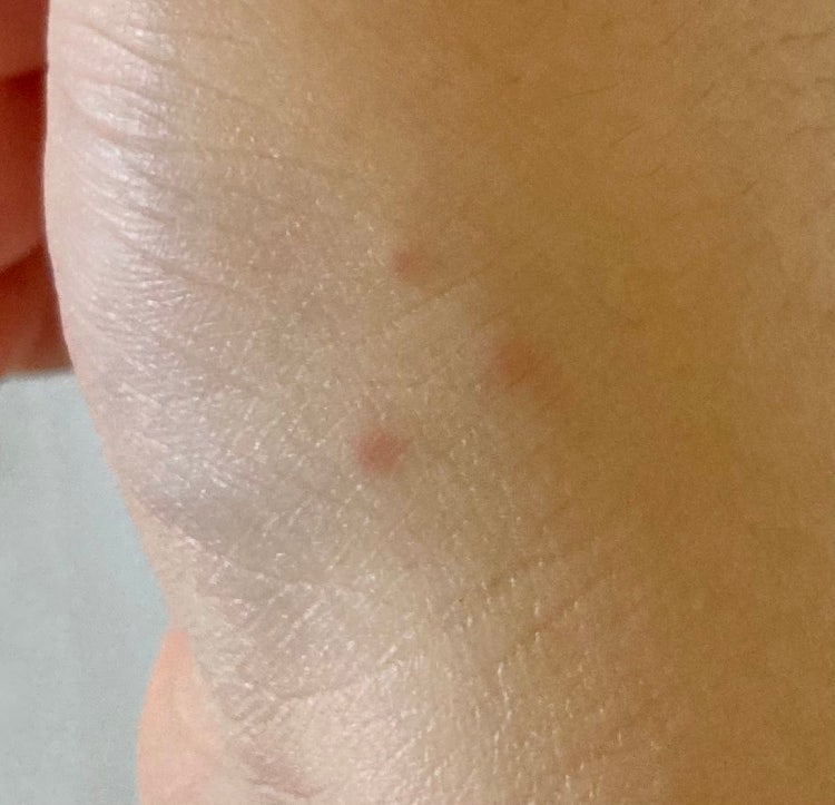 피부에 빨간 두드러기? 알러지 같은 거 뭔가요?ㅠㅠ : 지식iN