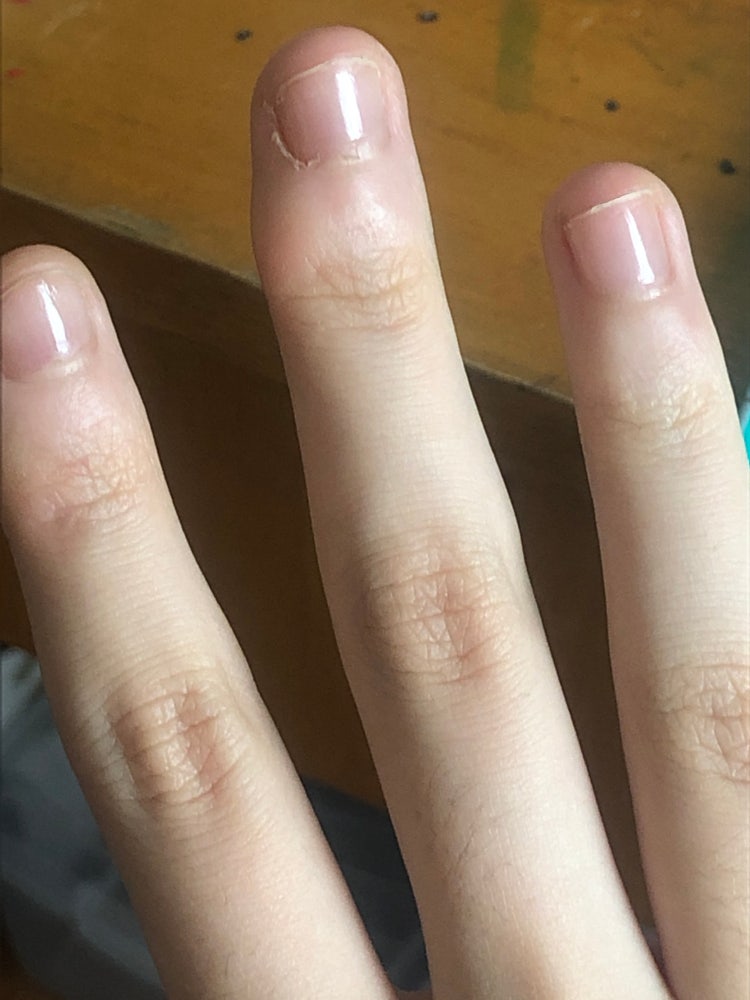 중지 손가락 굳은살?? 없앨순 없나요 : 지식iN 중지 손가락 굳은살?? 없앨순 없나요 : 지식In