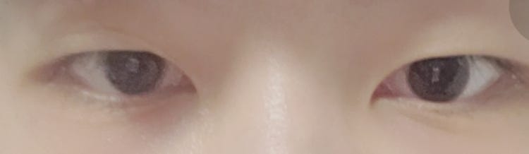 속쌍 눈매교정 하면 : 지식iN