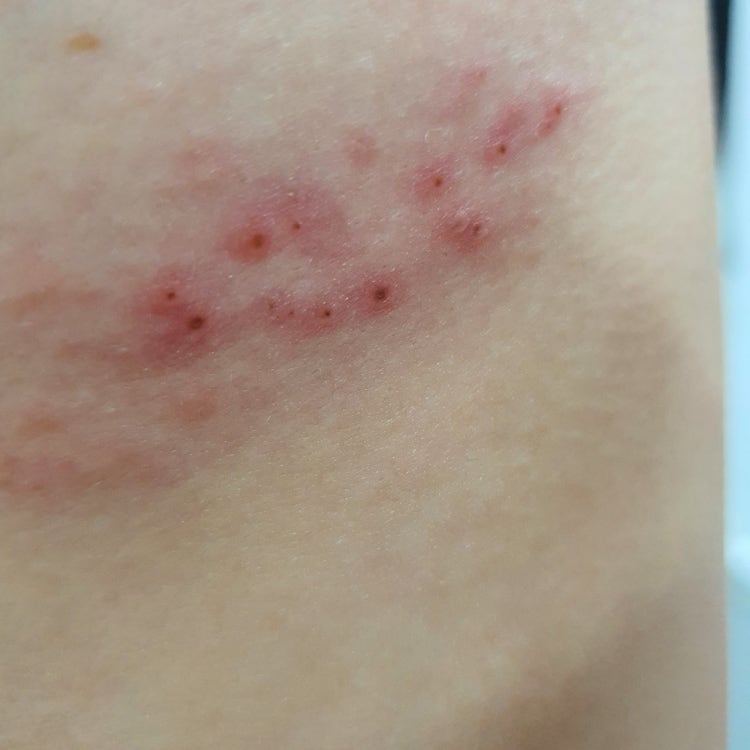 대상포진 인가요..(사진) : 지식iN