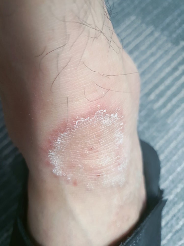 발등 무좀? 습진? 한포진? 사진 첨부 (혐 조심) : 지식iN