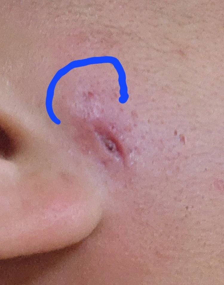 표피낭종 수술 후 흉터 질문 : 지식iN 표피낭종 수술 후 흉터 질문 : 지식In