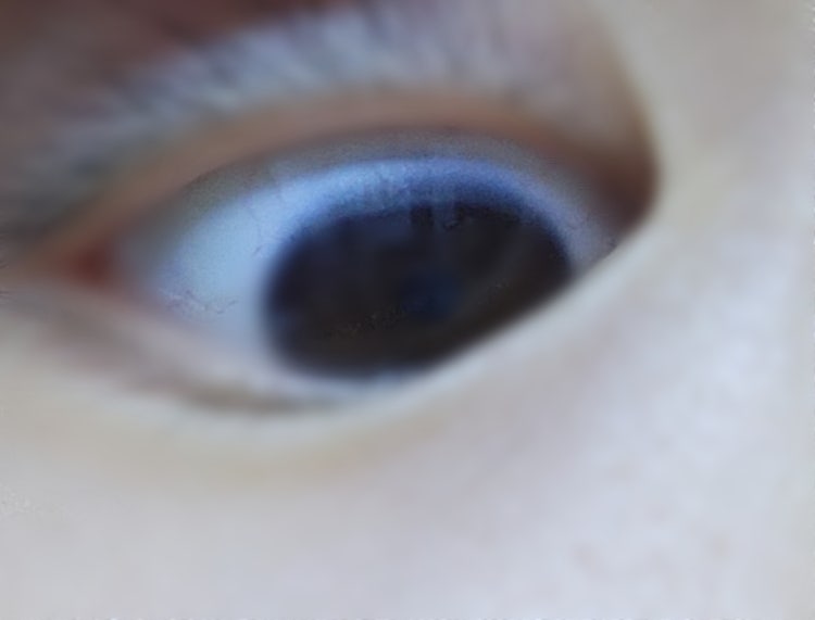 눈알 검은자 주변검정태? : 지식iN