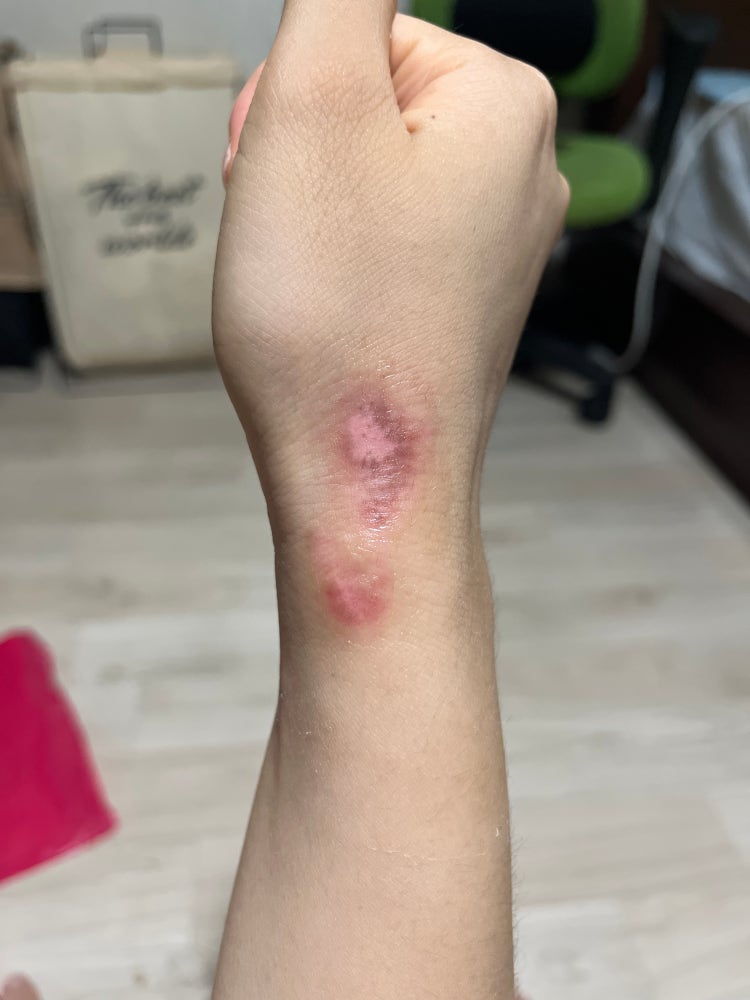 화상흉터제거 : 지식iN 화상흉터제거 : 지식In