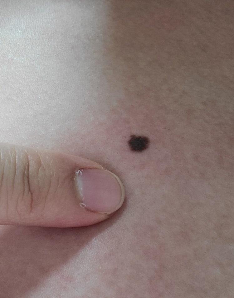 피부 점 흑색종 질문 : 지식iN