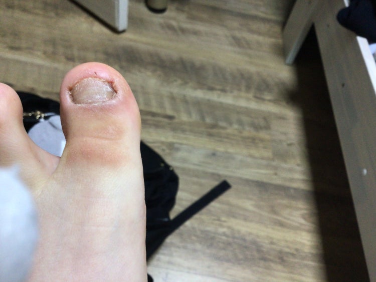발가락 굳은살 : 지식iN 발가락 굳은살 : 지식In