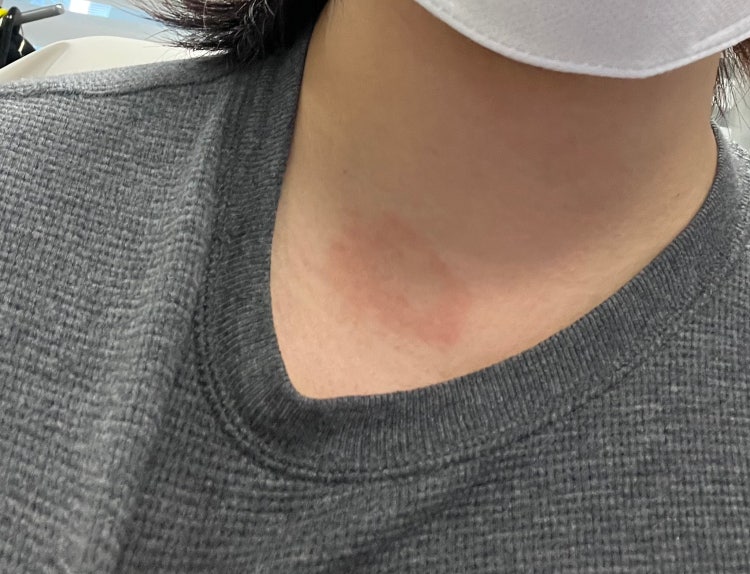 체부백선 인가요?(사진) : 지식iN