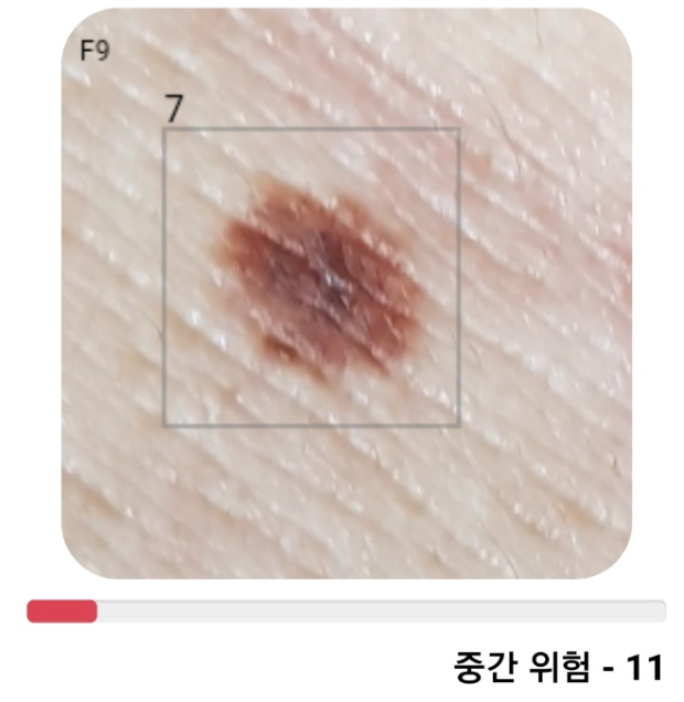 모반, 이형성, 흑색종 등 점 검사를 앱으로 했습니다. : 지식iN