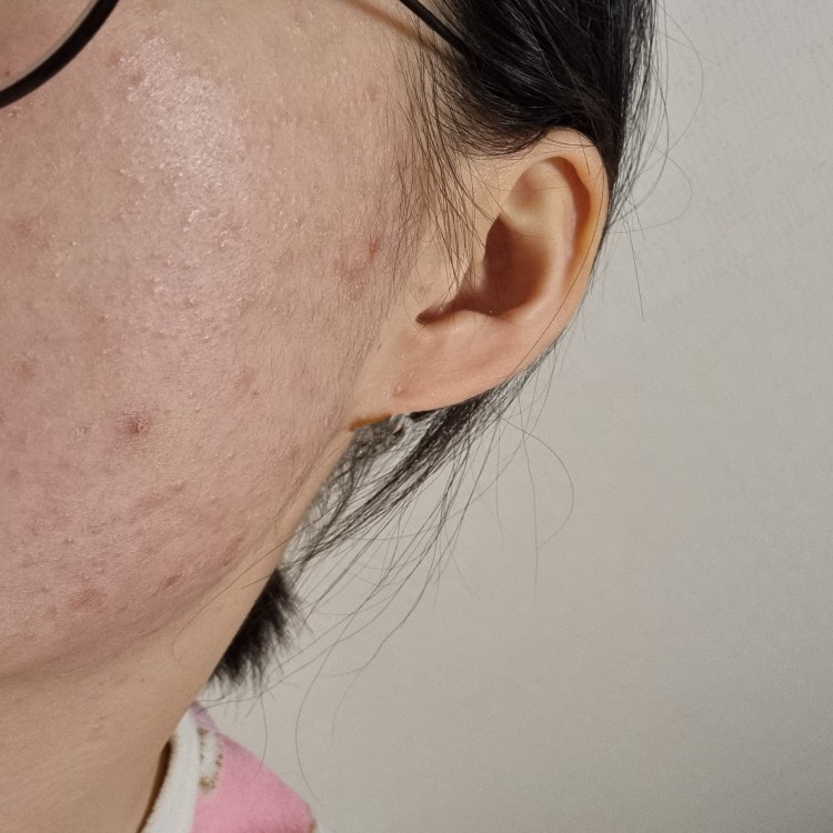 피부 속 박힌피지 해결법 : 지식iN