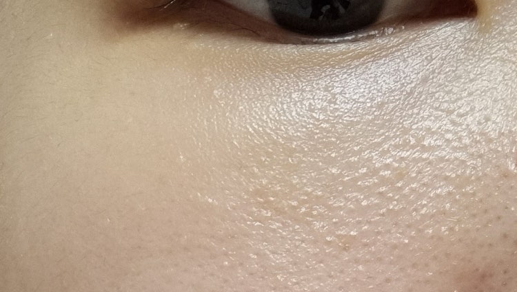 피부 요철 이름 : 지식iN