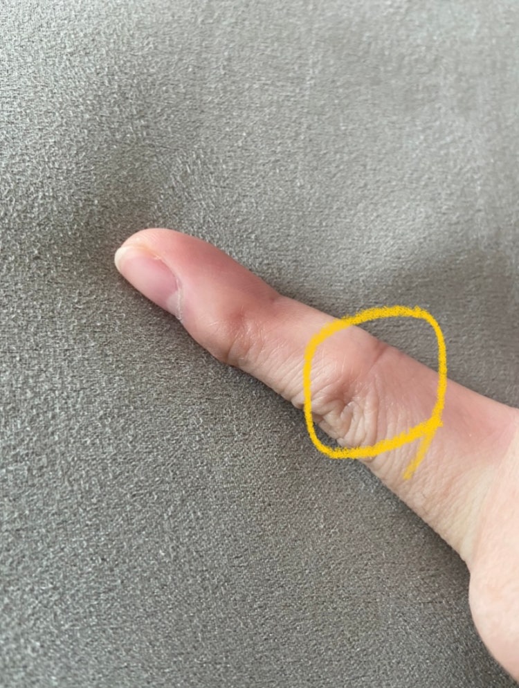 손가락 인대 파열 : 지식iN