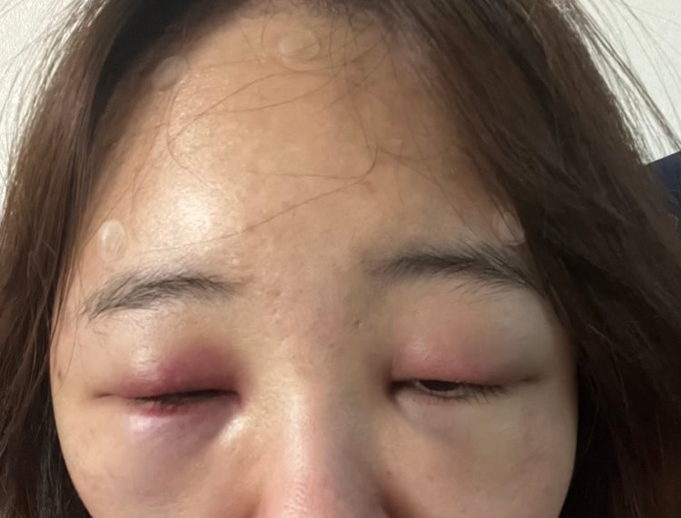 이마필러 붓기 : 지식iN 이마필러 붓기 : 지식In