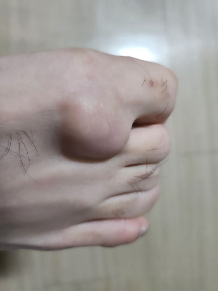 발가락 물혹??인가요 : 지식iN