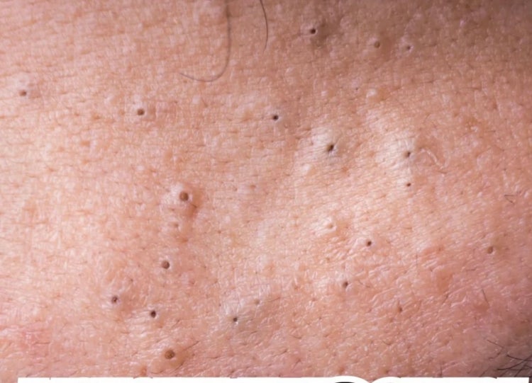 볼(얼굴)에 검은 블랙헤드?피지? 지식iN