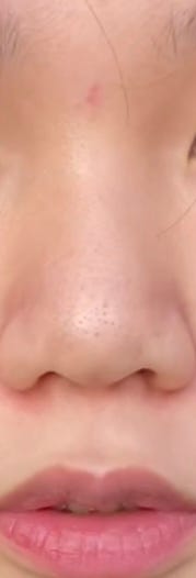 코 성형 어떻게.? : 지식iN