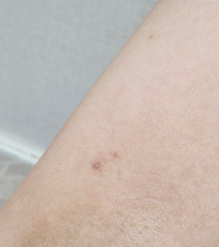 겨드랑이 윗부분 포진 물집 간지러움 이게 뭘까여 : 지식iN
