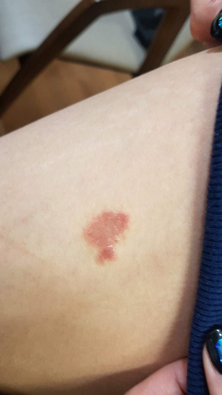 피부 붉은 반점 가려움 : 지식iN