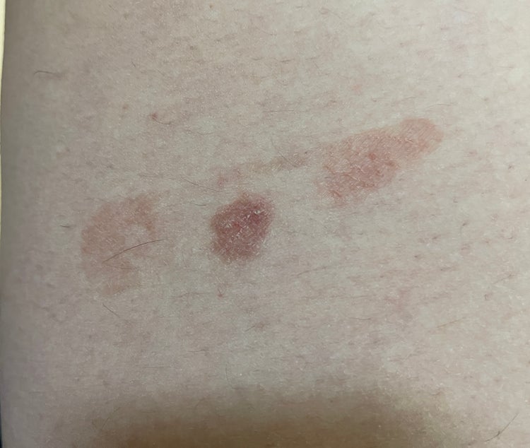 피부 붉은 반점? 습진? 뭘까요 : 지식iN