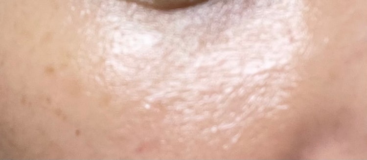 피부요철 종류가 뭘까요!! : 지식iN
