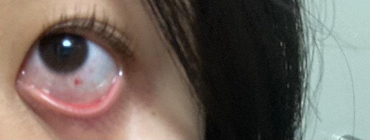 렌즈 있는지 없는지... 글고 눈알 상처 : 지식iN